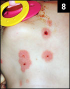 Figure 8: Herpes simplex infection