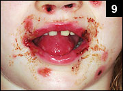 Figure 9: Herpes simplex infection