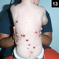 Figure 13: An unusual case of bullous varicella complicated by group A strep infection 