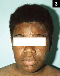 Figure 3: Relatively mild disease