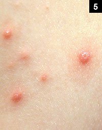 Figure 5: Varicella classic rash