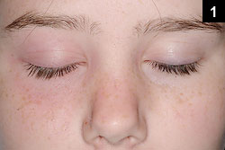 There was mild erythema and swelling of the periorbital soft tissues of the right eye