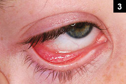 The patient also presented with conjuctival erythema