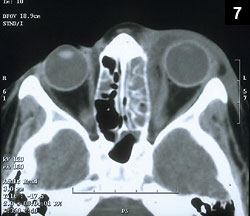 CT scan of ethmoid sinusitis