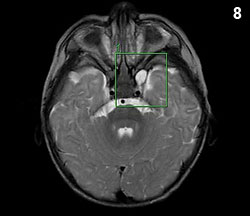 MRI scan of a patient with an orbital encephalocele