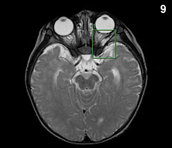 The defect extends from deep within the base of the brain to the area next to the left lateral rectus