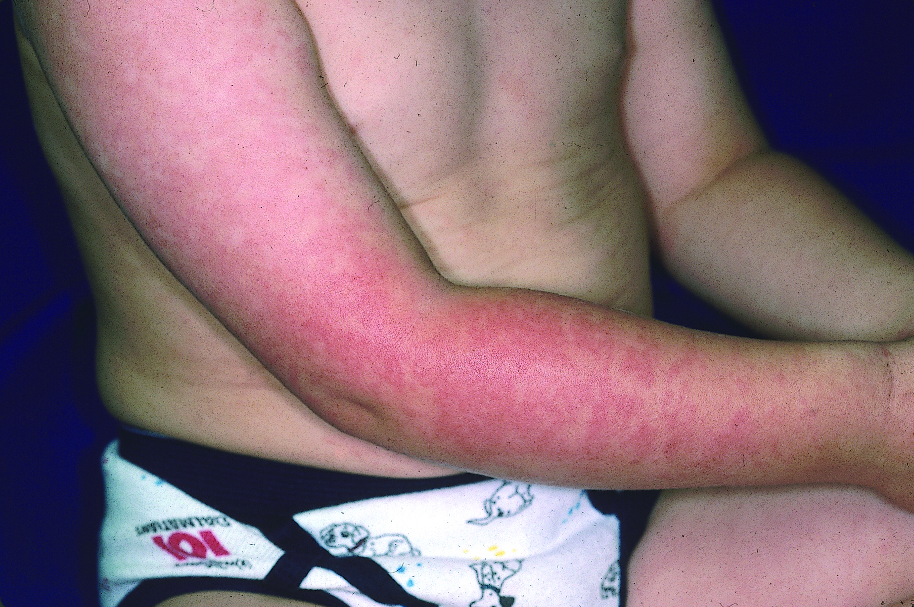 Young boy with rash on arms and body