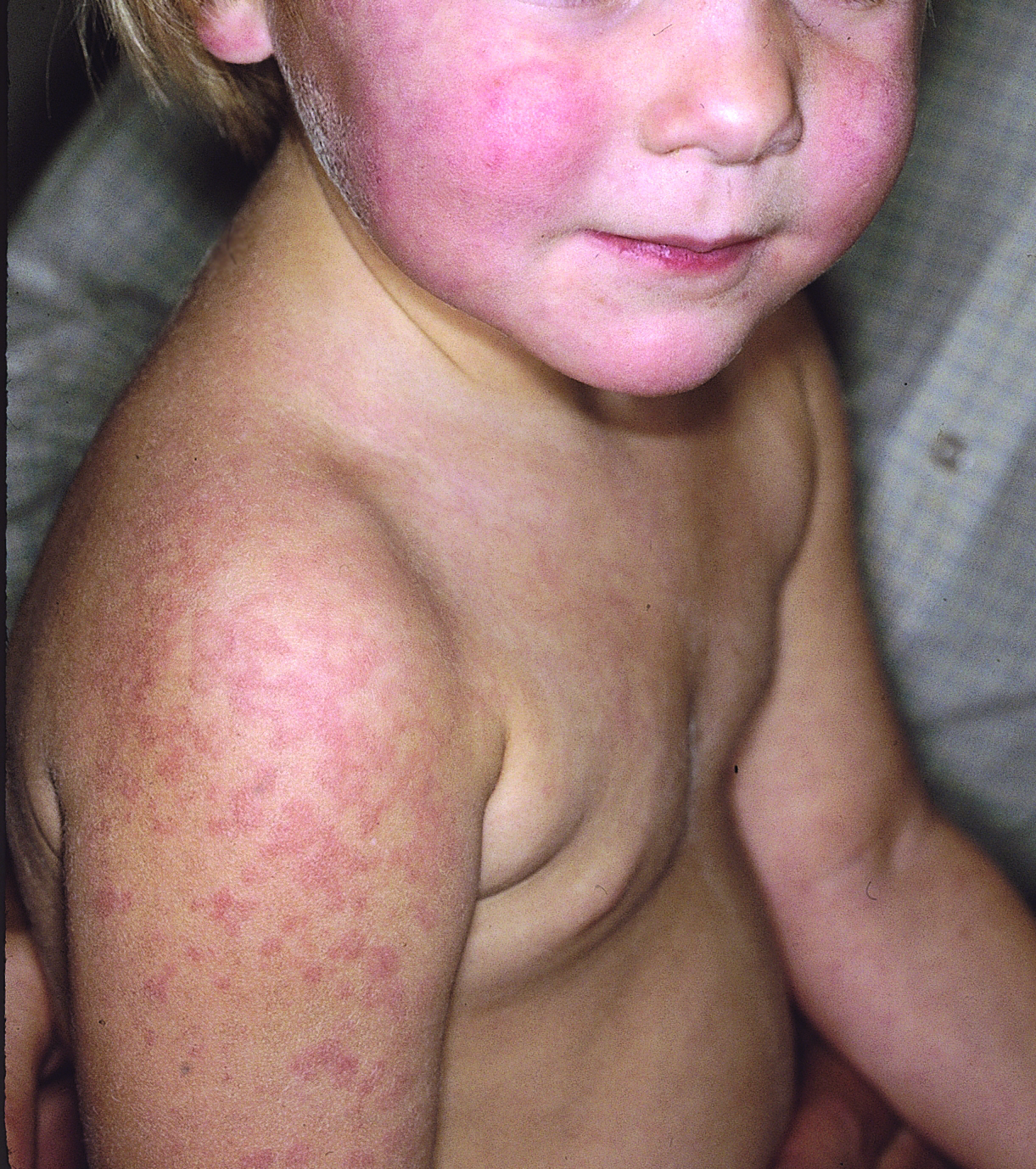 Young boy with rash on arms and body