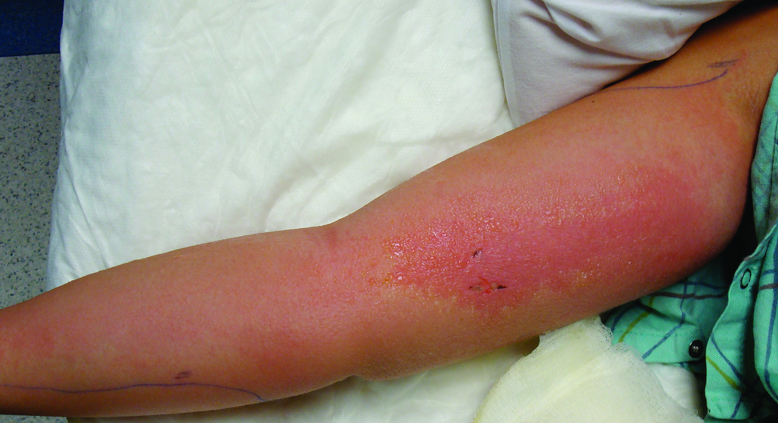 Photo of child's arm with rash