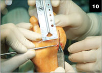 The podiatrist removed the retained splinter when the  patient returned with a recurrent infection