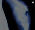 Radiograph showing bone damage