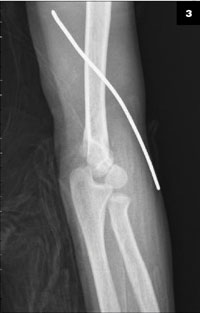 Radiographs of the patient's injuries