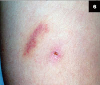 A small, linear, erythematous mark adjacent to the entry wound