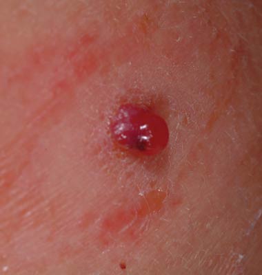 Pyogenic granuloma