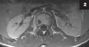 Figure 2: MRI showed a paraspinal phlegmon extending from the 12th thoracic vertebrae to the second lumbar vertebrae, with no abscess.