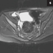 Figure 5: Osteomyelitis is a rare presentation of Bartonella henselae as shown in the ilium above.