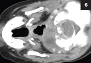 Figure 6: The adenopathy can also be a cause for retropharyngeal adenopathy and cellulitis.