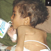 Figure 7: Patient in Afghanistan with Pott Disease.