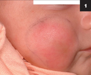 Figure 1: The patient had an area of erythema and swelling over her right cheek, with some brownish discoloration in the center of the area.