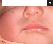 Figure 2: The patient had an area of erythema and swelling over her right cheek, with some brownish discoloration in the center of the area.