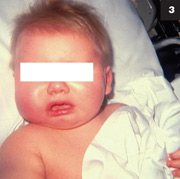 Figure 3: Children with Haemophilus influenzae type b buccal cellulitis are often febrile and sick-appearing.