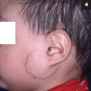 Figure 4: A patient with parotitis.