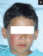 Figure 5: If an older child had a cheek cellulitis, it may look similar as a maxillary tooth abscess.