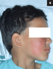 Figure 6: If an older child had a cheek cellulitis, it may look similar as a maxillary tooth abscess.