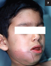 Figure 7: A mandibular tooth abscess would be located farther down on the face or neck, as shown above.