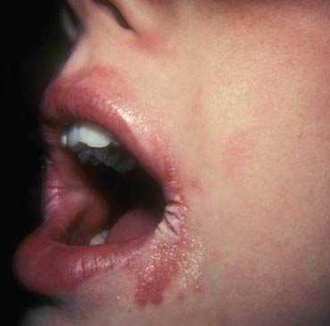 Perleche, or angular chelitis, can cause a painful rash in the corners of the mouth.