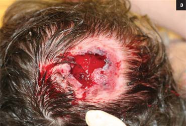 Figure 2: Hair loss was difficult to appreciate, but there appeared to be no loss of hair. In fact, the hair had to be shaved to see the lesion.