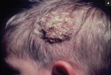 Figure 4: Tinea capitis and kerions are usually accompanied by hair loss, as shown above.