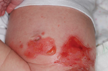 The patient was noted to have blistering on the abdomen shortly after birth.