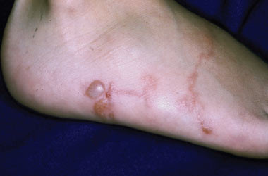 The patient had an intensely pruritic focally blistering eruption tracking along the dorsum of his right foot.