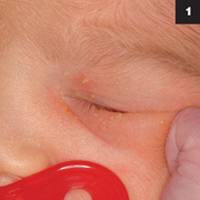 Figure 1: The rash consisted of several small pustular lesions located about the left eye.