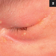 Figure 2:  The rash consisted of several small pustular lesions located about the left eye.