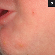 Figure 3: The patient also had several scattered lesions on the chin and trunk.