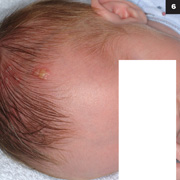 Figure 6: If the rash was herpes, the lesions would likely to be somewhat larger and in coalescing clusters.