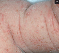 Figure 7: A patient with neonatal candidiasis.