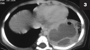 Figure 3: Abcess formed by Staphylococcus aureus, shown in the figures above.