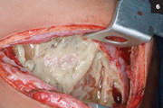 Figure 6: Drainage and physical debridement of purulent material and debris.