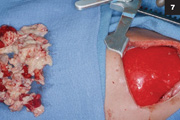 Figure 7: Drainage and physical debridement of purulent material and debris.