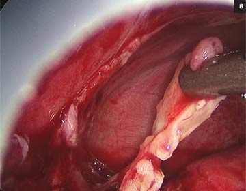 Figure 8: The procedures shown in Figures 6 and 7 can be done less invasively with video-assisted thorascopic surgery (VATS), as shown above.