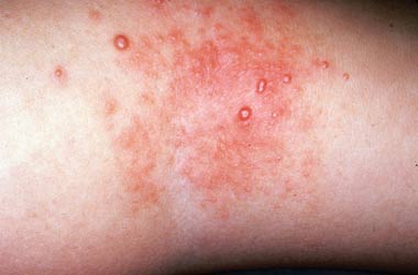 Molluscum is commonly found in association with dermatitis here involving the antecubital fossa.