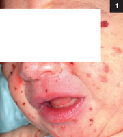 Figure 1: The patient had an extensive rash consisting of dozens of discrete, apparently blistering, excoriated-appearing lesions with no erythemia.