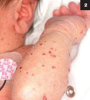 Figure 2: The patient had an extensive rash consisting of dozens of discrete, apparently blistering, excoriated-appearing lesions with no erythemia.