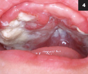 Figure 4: Other manifestations may include oral lesions, including gingival hypertrophy with ulcerations.