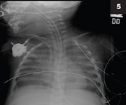 Figure 5: Severe pulmonary infiltrative disease and mandibular destruction.