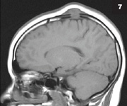 Figure 7: Eosinophilic granuloma consists only of lytic bone lesion(s), as shown in the picture and scan above.