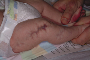 The vascular pattern of CMTC can sometimes have a course, 